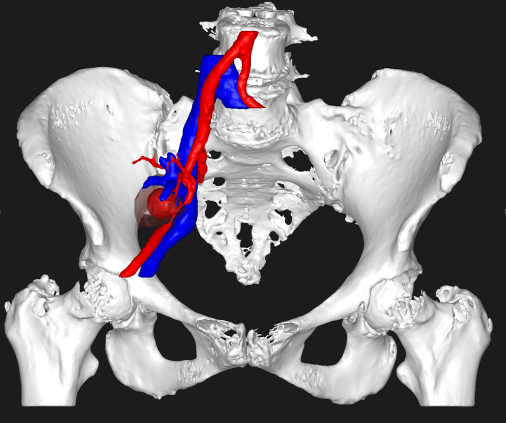 Aneurysms